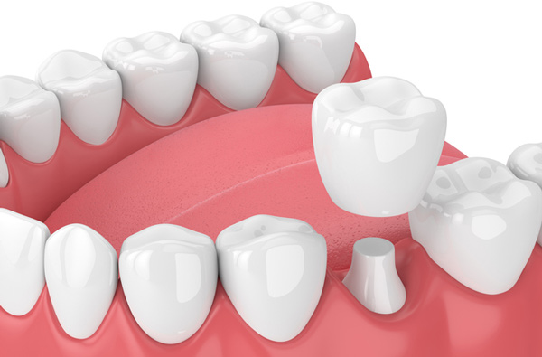 Rendering of jaw with dental crown at Radiance Dental in West Chester, PA