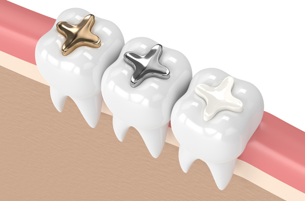 Rendering of teeth with 3 filling materials at Radiance Dental in West Chester, PA