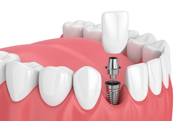 Rendering of jaw with dental implant at Radiance Dental in West Chester, PA