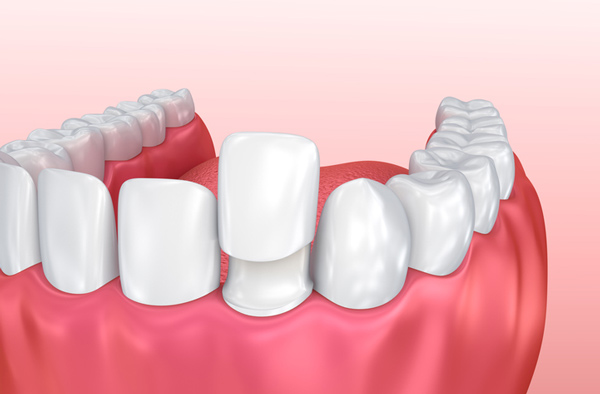 Rendering of jaw with porcelain veneer on tooth at Radiance Dental in West Chester, PA