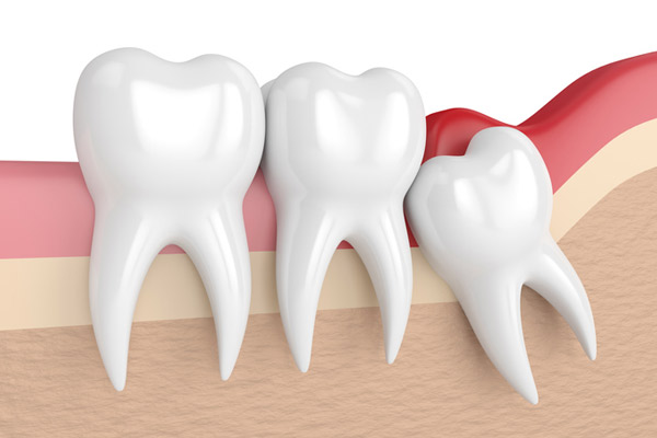 Illustration of an impacted wisdom tooth at Radiance Dental in West Chester, PA